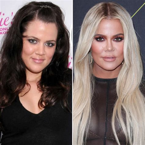 chloe plastic surgery|Khloe Kardashian Plastic Surgery: Before, After Photos.